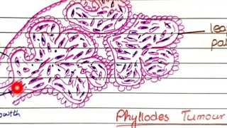 Fibroadenoma And Phyllodes Tumor  Pathology [upl. by Eelrehpotsirhc749]