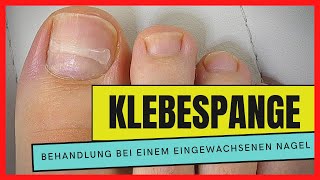 EINGEWACHSENEN NAGEL mit einer KLEBESPANGE behandeln  Podostripe Klebespange [upl. by Taryn764]