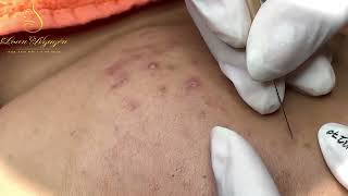 Loan Nguyen Acne Treatment 1244 [upl. by Portuna]