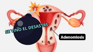 DIU MIRENA MIOMAS ADENOMIOSIS ENDOMETRIOSIS ACTUALIZACIÓN ¿QUE ME HA PASADO 😨 [upl. by Higginbotham503]