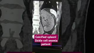 Calcified spleen Sickle cell anemia spleen anemia ctscan calcification radiology coreim [upl. by Dupaix]