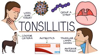 Understanding Tonsillitis [upl. by Kuth29]