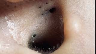 Big Cystic Acne Blackheads Extraction Blackheads amp Milia Whiteheads Removal Pimple Popping  2753 [upl. by Aikcir657]