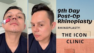 Rhinoplasty In the Philippines 9th Day Post Opp [upl. by Annabell]