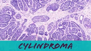 Cylindroma benign sweat gland skin adnexal tumor pathology dermpath dermatology dermatopathology [upl. by Nilkoorb159]