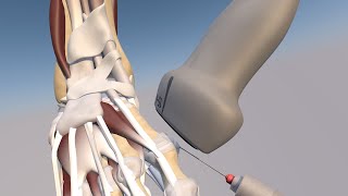 3D Model of a Ultrasound Guided First Metatarsophalangeal Joint Injection by probeultrasound [upl. by Ajna353]