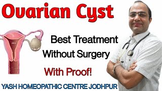 Ovarian Cyst ।PCOD  अंडाशय की सिस्ट।गाँठ PCOS without surgery best homeopathic treatment [upl. by Tiffie]