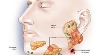 salivary gland tumors [upl. by Yentruoc]