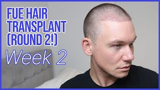 WEEK 2  FUE Hair Transplant Round 2  Removing Scabs and Losing Hair Shafts [upl. by Adlih]