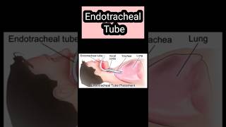 What is endotracheal tube endotrachealtube trachea ventilator shorts shortsfeed radiology [upl. by Allen]