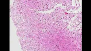 Histopathology LiverHerpes hepatitis [upl. by Nimrak]