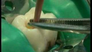 Endodontie mécanisée le système PROTAPER® principes et guide dutilisation [upl. by Gimble378]