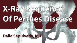 XRay Sequence Of Perthes Disease [upl. by Frodeen]