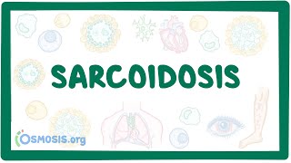 Sarcoidosis  causes symptoms diagnosis treatment pathology [upl. by Adnawyek182]