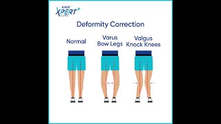 Legs Deformity Correction  Knee Xpert [upl. by Cate]