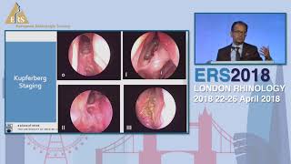 ERS London 2018 Allergic Fungal CRS Update On Diagnosis And Medical Management Amin Javer [upl. by Ahseina]