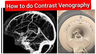 Contrast Venography MRI Scan Protocol Positioning amp Planning  Live Demo in English [upl. by Canale]