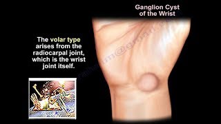 Ganglion Cyst Wrist  Everything You Need To Know  Dr Nabil Ebraheim [upl. by Ruhl694]