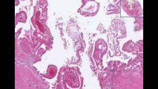 Histopathology GallbladderAcute cholecystitis [upl. by Aniratak389]