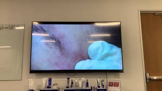 Dr Obagi demonstrating extractions and kenalog injections into acne cysts [upl. by Bass]