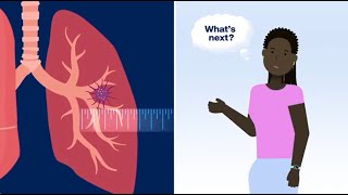 What Happens After Your Doctor Finds a Lung Nodule Pulmonary Nodule [upl. by Tram]