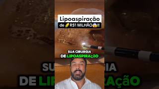 VC PAGARIA 1🌽 MILHÃO NA LIPO lipohd renuvion vaser vibrolipo lipoaspiração [upl. by Ecyla]