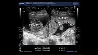 Ultrasound Video showing Anencephaly in a Pregnancy of about 20 weeks [upl. by Fauch]