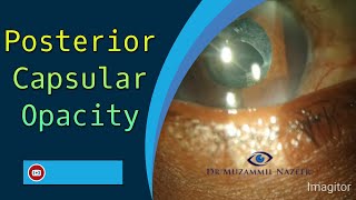 Posterior Capsular OpacityPCO on slit lampAlso known as Secondary Cataract [upl. by Tennaj]