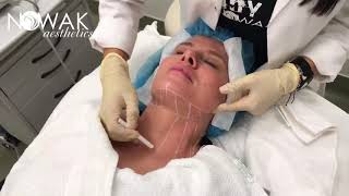 Ultherapy Procedure Chin Strap amp Neck Treatment [upl. by Anyalram801]