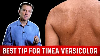 Natural Skin Fungus Tinea Versicolor Home Remedies – Dr Berg [upl. by Huey]