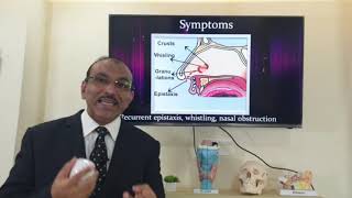 Septal perforation Hindi Patient teaching programme [upl. by Hu]