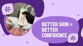 BETTER SKIN  BETTER CONFIDENCE losangeles acnetreatment reels dermatology shorts shortsvideo [upl. by Campball]