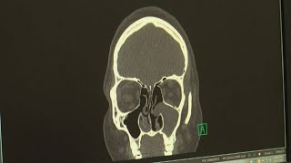 3D sinus surgery [upl. by Farrand]