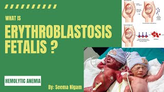 Erythroblastosis FetalisRh incompatibility and Hemolytic disease of the newborn HDN [upl. by Goober]