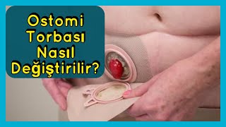 Stoma nedir  Ostomi Torbası Nasıl Değiştirilir [upl. by Lapointe]