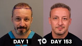 HAIR TRANSPLANT TIMELAPSE  DAY 1 TO DAY 153  GROWTH IN 5 MONTHS  BEFORE amp AFTER [upl. by Erdnoed]