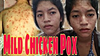 My Chicken Pox journeyBulutonghangga [upl. by Neil]