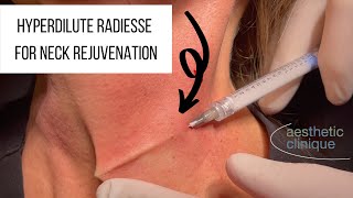 Hyperdilute Radiesse Calcium Hydroxyapatite For Neck Rejuvenation  triNECKta [upl. by Yerac]