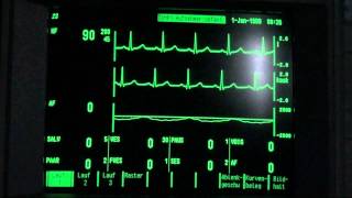 ECG  EKG paroxysmal supraventricular tachycardia holiday heart syndrome vs sick sinus syndrome [upl. by Berger]