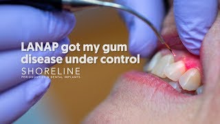 Treat periodontal disease with less pain Dr Urbanski explains the LANAP procedure [upl. by Adnomal938]