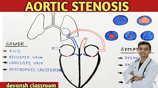 Aortic valve stenosis causes  symptoms pathology in hindi [upl. by Femmine654]