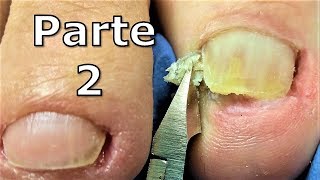 como sacar uña encarnada  como obter uma unha encravada  Impacted or Ingrown Toenail Pedicure [upl. by Joletta152]