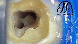 CShaped Lower Second Molar  Root Canal Morphology  Complex RC Anatomy  Endodontic Variations [upl. by Namialus]