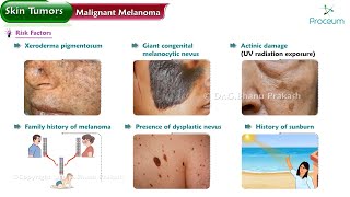 Malignant Melanoma Risk factors Types Characteristic features Diagnosis Surgery [upl. by Solhcin]