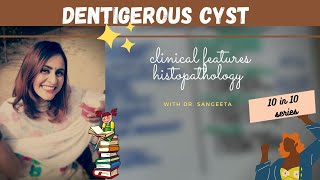 dentigerous cyst lecture I dental lectures [upl. by Kciremed290]