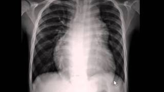 Chest xray  pulmonary arterial hypertension [upl. by Reece]