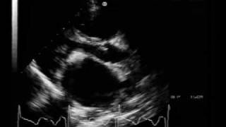 MS different aspectscalcified mitral stenosis [upl. by Sioux]