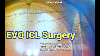 EVO ICL with cornea neovascularization Shannon Wong MD [upl. by Jeremias427]