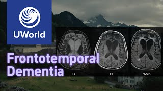 Frontotemporal Dementia vs Alzheimer Disease with Histology  UWorld USMLE MBBS [upl. by Hachman]