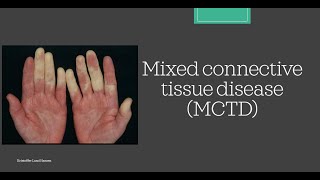 MCTD Mixed Connective Tissue Disease Essential medicine [upl. by Dry]